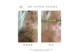 Be Lifted Plasma & Purebeau Fibroblast By KS Skin Solutions
